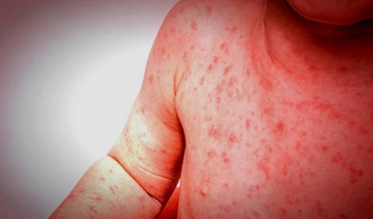 Epidemija ospica na Novom Zelandu: Više od 1000 oboljelih